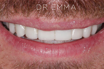 After - Dr Emma Facial Aesthetics