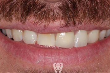 Before - Dr Emma Facial Aesthetics