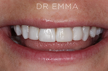 After - Dr Emma Facial Aesthetics