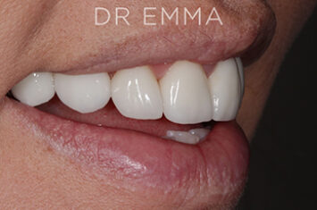 After - Dr Emma Facial Aesthetics