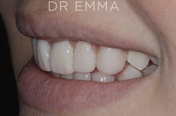 After - Dr Emma Facial Aesthetics