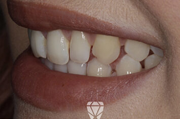 Before - Dr Emma Facial Aesthetics
